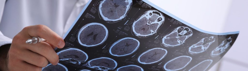Five Benefits of Hiring a Brain Injury Attorney