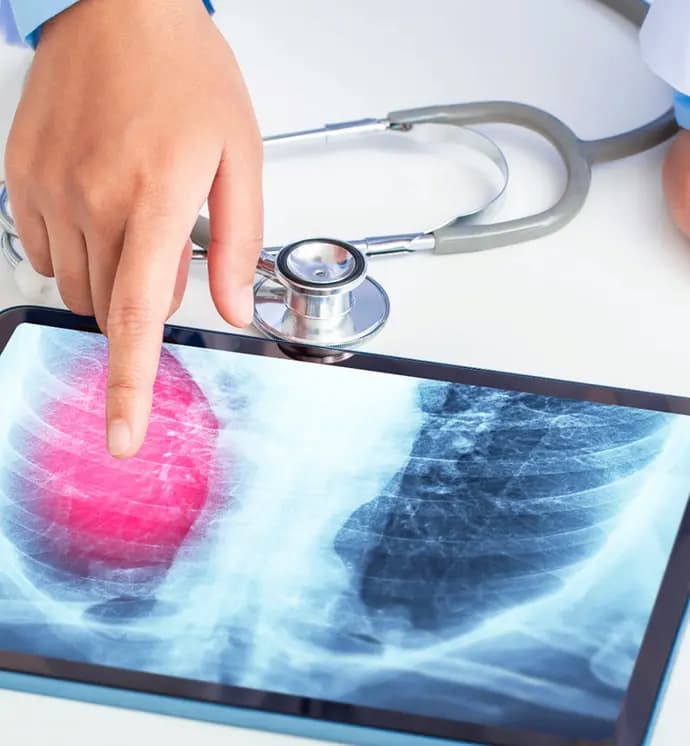 lung cancer attorneys